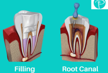 Cavity vs Root Canal