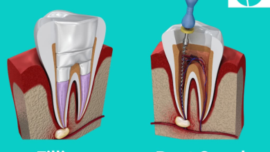Cavity vs Root Canal