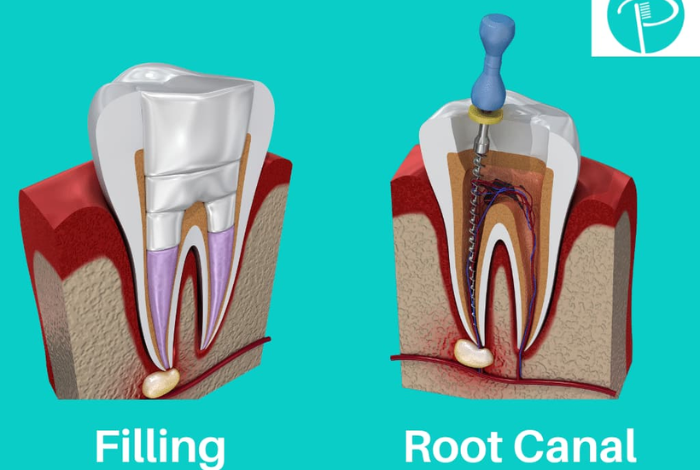 Cavity vs Root Canal