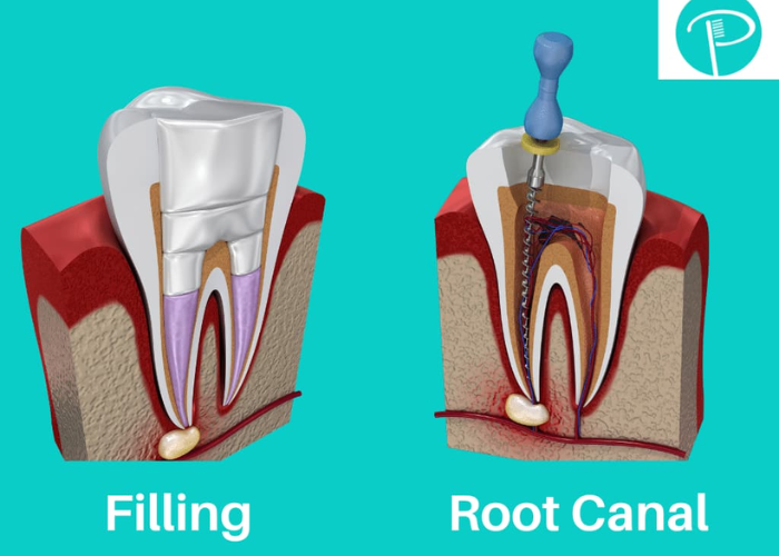 Cavity vs Root Canal